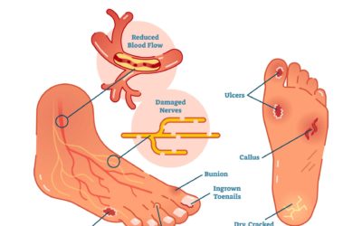 L’AMÉLIORATION DES SOINS PERMET UNE DIMINUTION DES AMPUTATIONS MAJEURES ET DES HOSPITALISATIONS LIÉES AUX COMPLICATIONS DU PIED CHEZ LES PERSONNES DIABÉTIQUES